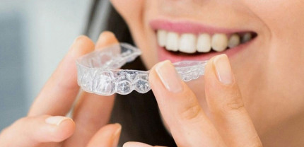 Women holding dental aligner
